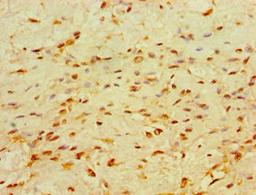 Immunohistochemistry of paraffin-embedded human breast cancer using CSB-PA005325ESR2HU at dilution of 1:100