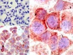 Immunohistochemistry-Paraffin: NFkB p65 NLS Antibody [NBP2-24541] - NFkB p65 NLS Antibody analysis of p65 NLS in formalin-fixed, paraffin-embedded human HeLa cells (top left) and LPS-stimulated HeLa cells (bottom left, right) using p65 NLS antibody at 5 ug/ml.