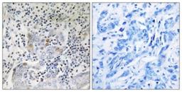 Immunohistochemistry-Paraffin: SESN1 Antibody [NBP1-68677] - Analysis of paraffin-embedded human breast carcinoma tissue, using SESN1 Antibody. The picture on the right is treated with the synthesized peptide.