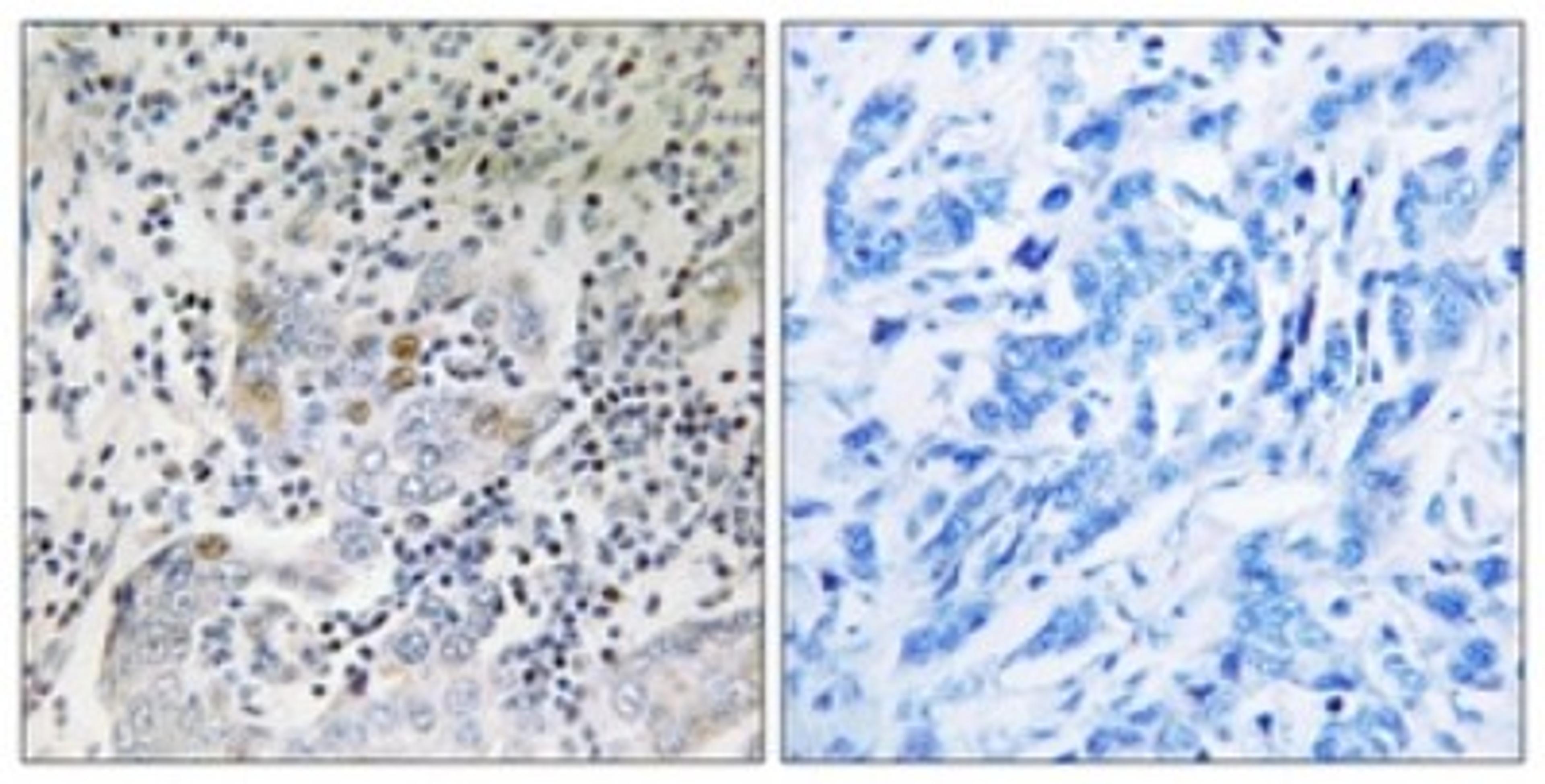 Immunohistochemistry-Paraffin: SESN1 Antibody [NBP1-68677] - Analysis of paraffin-embedded human breast carcinoma tissue, using SESN1 Antibody. The picture on the right is treated with the synthesized peptide.