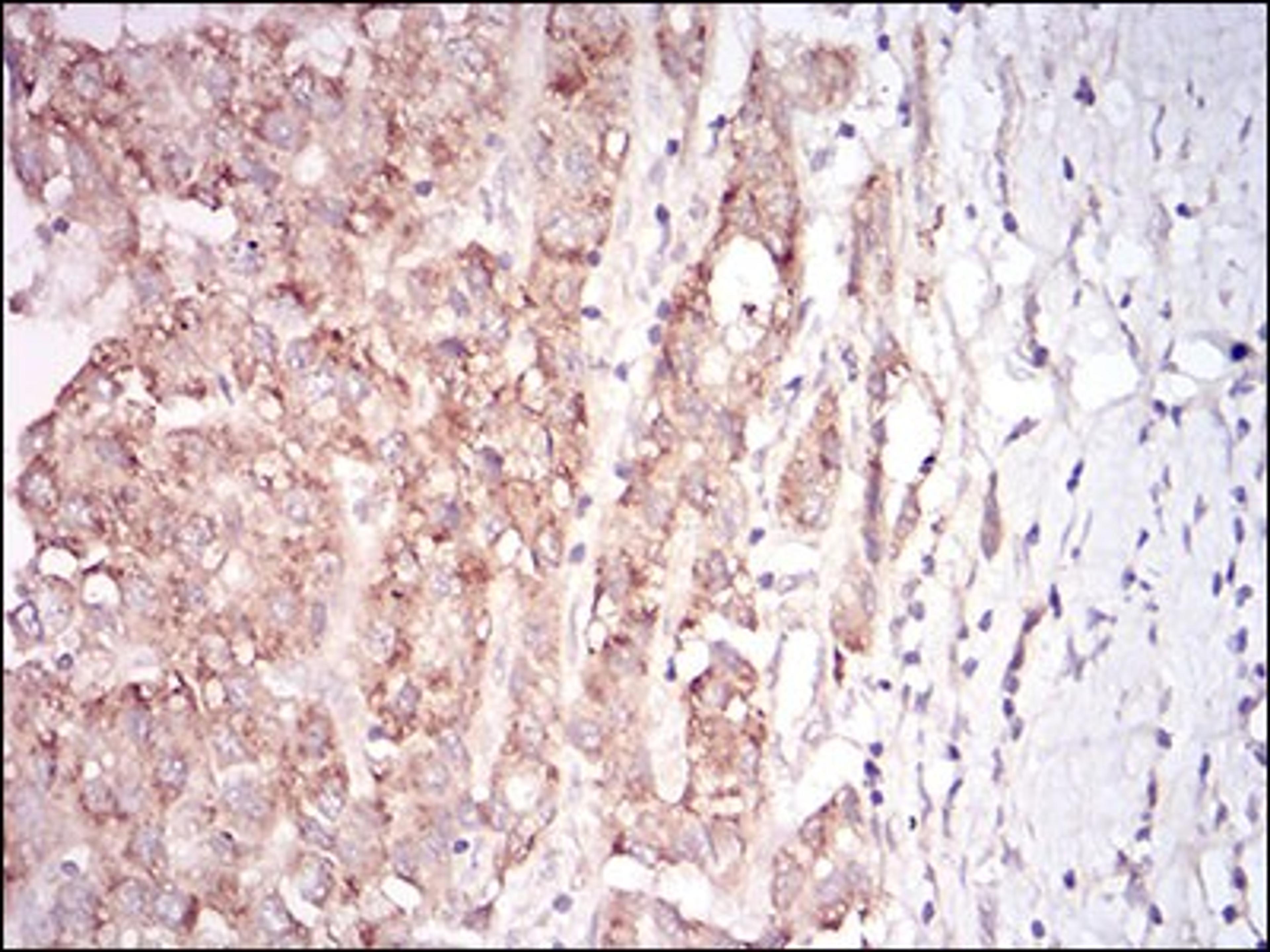 Immunohistochemistry: GDF-8/Myostatin Antibody (6E4B2) [NBP2-37260] - Immunohistochemical analysis of paraffin-embedded liver cancer tissues using MSTN mouse mAb with DAB staining.