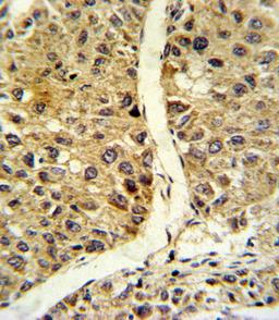 Formalin-fixed and paraffin-embedded human hepatocarcinoma reacted with NOS3 Antibody (N-term), which was peroxidase-conjugated to the secondary antibody, followed by DAB staining.