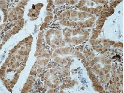 Immunohistochemical staining of throid cancer using ASGR2 antibody