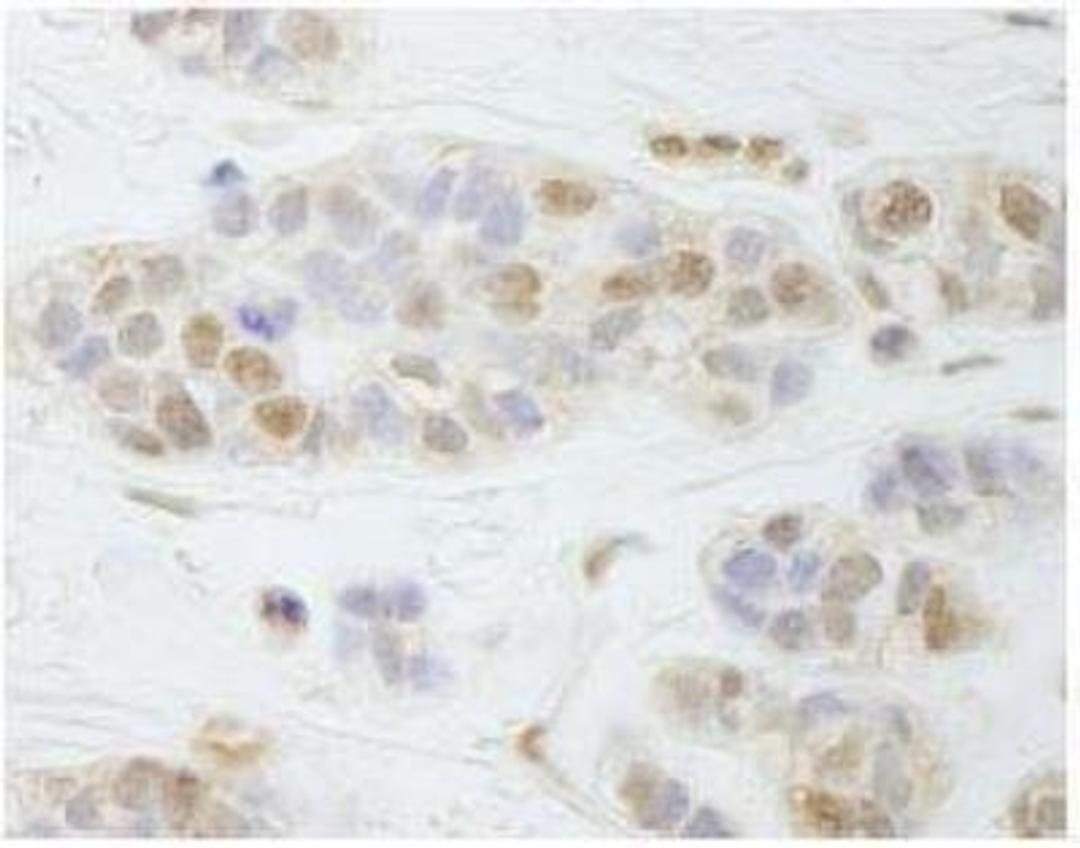 Immunohistochemistry-Paraffin: PALB2 Antibody [NB100-60439] - FFPE section of human breast carcinoma.  Affinity purified rabbit anti-PALB2 used at a dilution of 1:250.