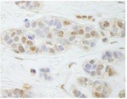 Immunohistochemistry-Paraffin: PALB2 Antibody [NB100-60439] - FFPE section of human breast carcinoma.  Affinity purified rabbit anti-PALB2 used at a dilution of 1:250.