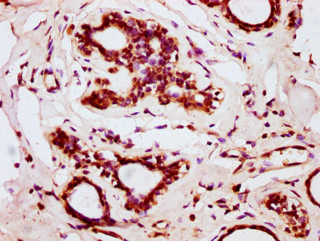 IHC image of CSB-PA867143LA01HU diluted at 1:200 and staining in paraffin-embedded human breast cancer performed on a Leica BondTM system. After dewaxing and hydration, antigen retrieval was mediated by high pressure in a citrate buffer (pH 6.0). Section was blocked with 10% normal goat serum 30min at RT. Then primary antibody (1% BSA) was incubated at 4&deg;C overnight. The primary is detected by a biotinylated secondary antibody and visualized using an HRP conjugated SP system.