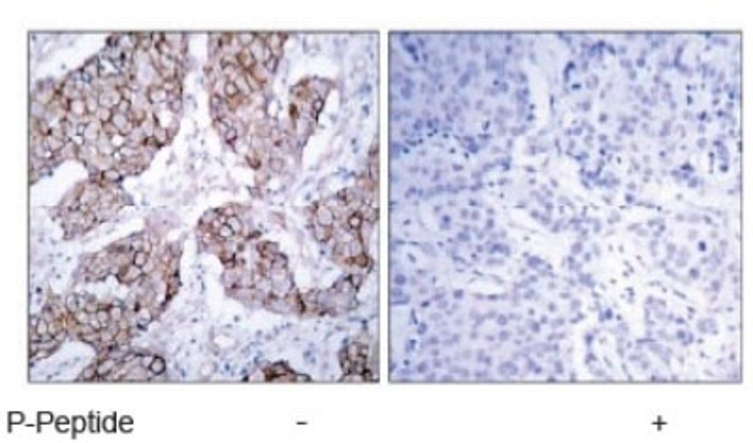 Immunohistochemistry: EGFR [p Tyr1092] Antibody [NB100-81894] - Immunohistochemical analysis of paraffin- embedded human breast carcinoma tissue using EGFR (phospho-Tyr1092) antibody