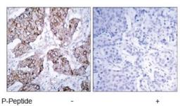 Immunohistochemistry: EGFR [p Tyr1092] Antibody [NB100-81894] - Immunohistochemical analysis of paraffin- embedded human breast carcinoma tissue using EGFR (phospho-Tyr1092) antibody