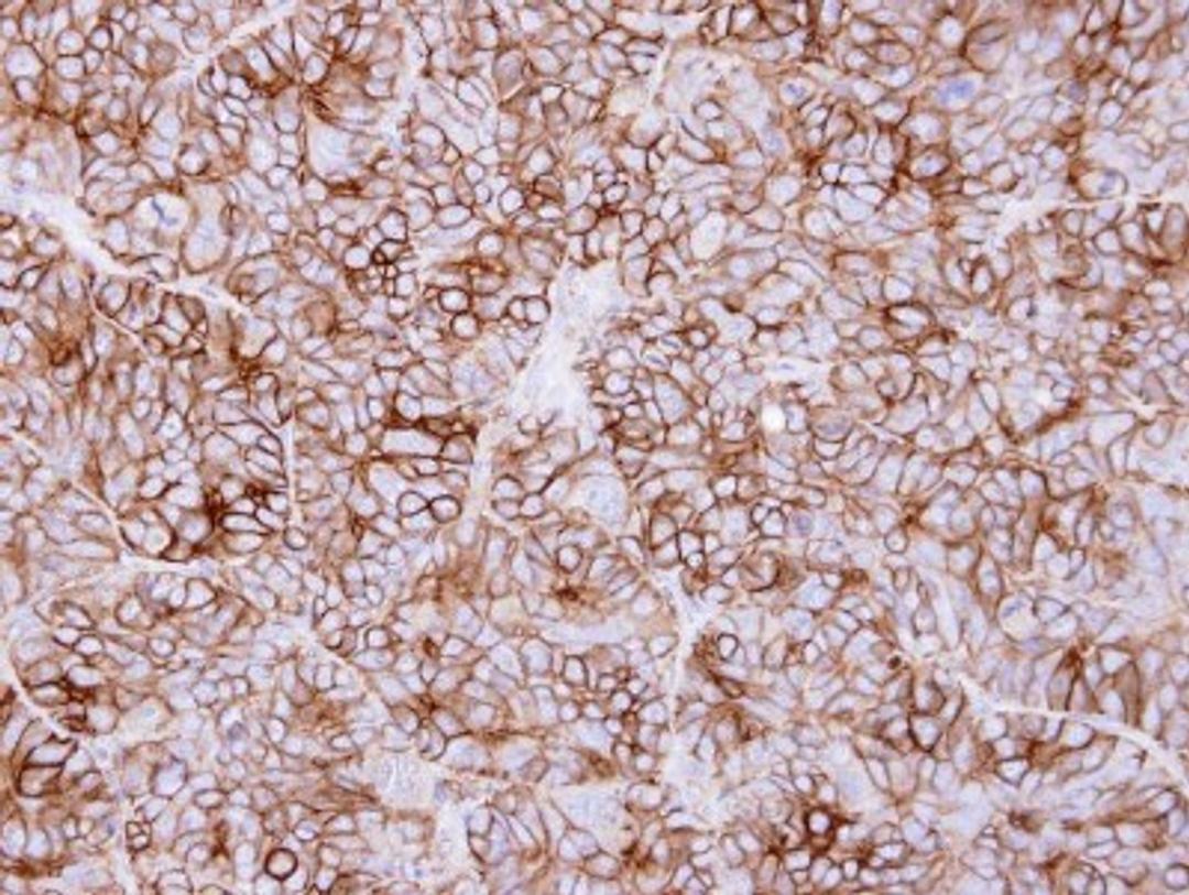 Immunohistochemistry-Paraffin: KIDINS220 Antibody [NBP1-31216] - Paraffin-embedded SW480 xenograft, using antibody at 1:500 dilution.