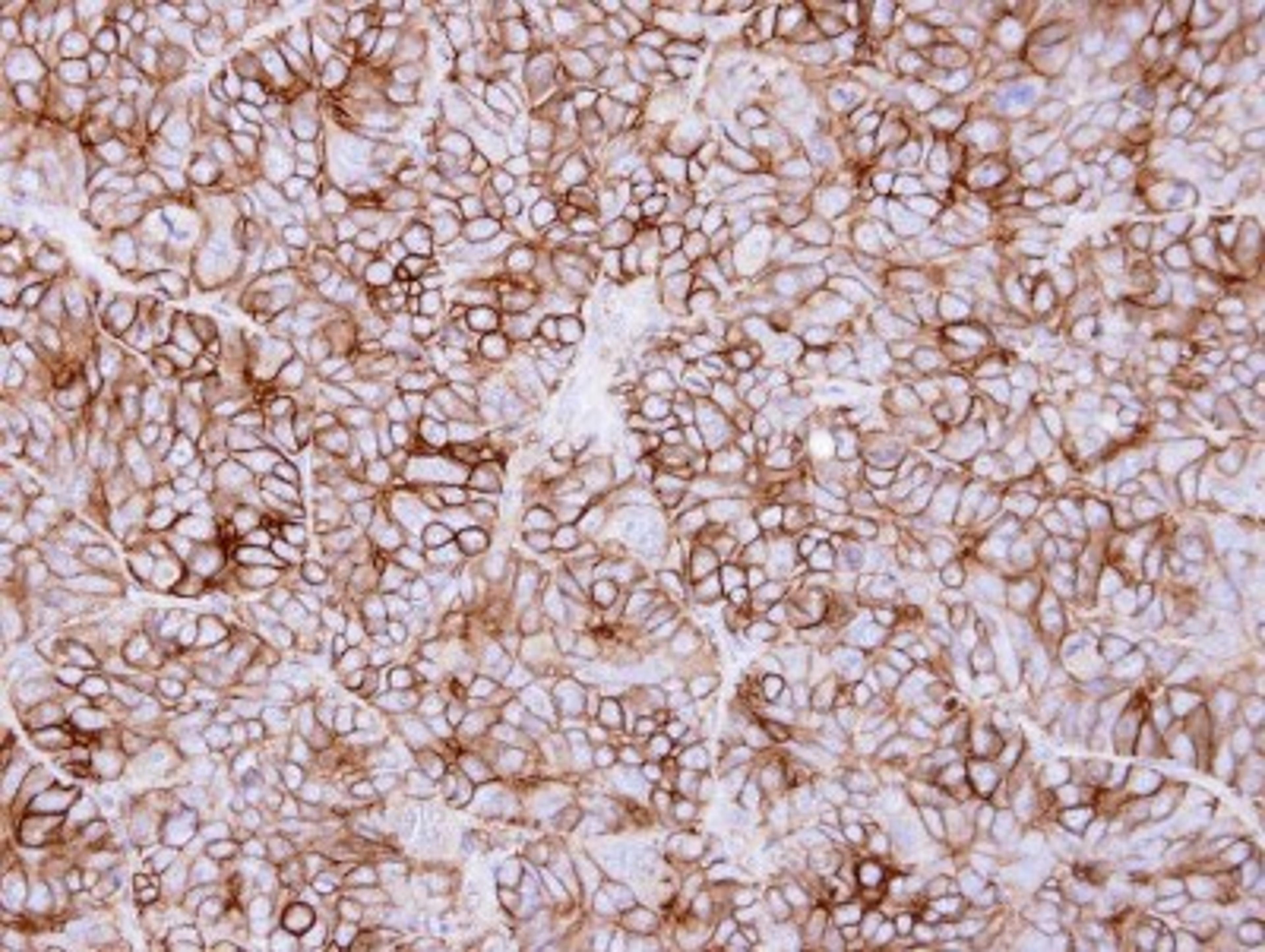 Immunohistochemistry-Paraffin: KIDINS220 Antibody [NBP1-31216] - Paraffin-embedded SW480 xenograft, using antibody at 1:500 dilution.