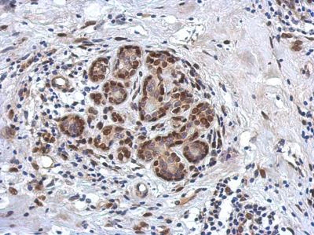 Immunohistochemistry-Paraffin: ZBTB20 Antibody [NBP2-20936] - Immunohistochemical analysis of paraffin-embedded Breast ca, using antibody at 1:750 dilution.