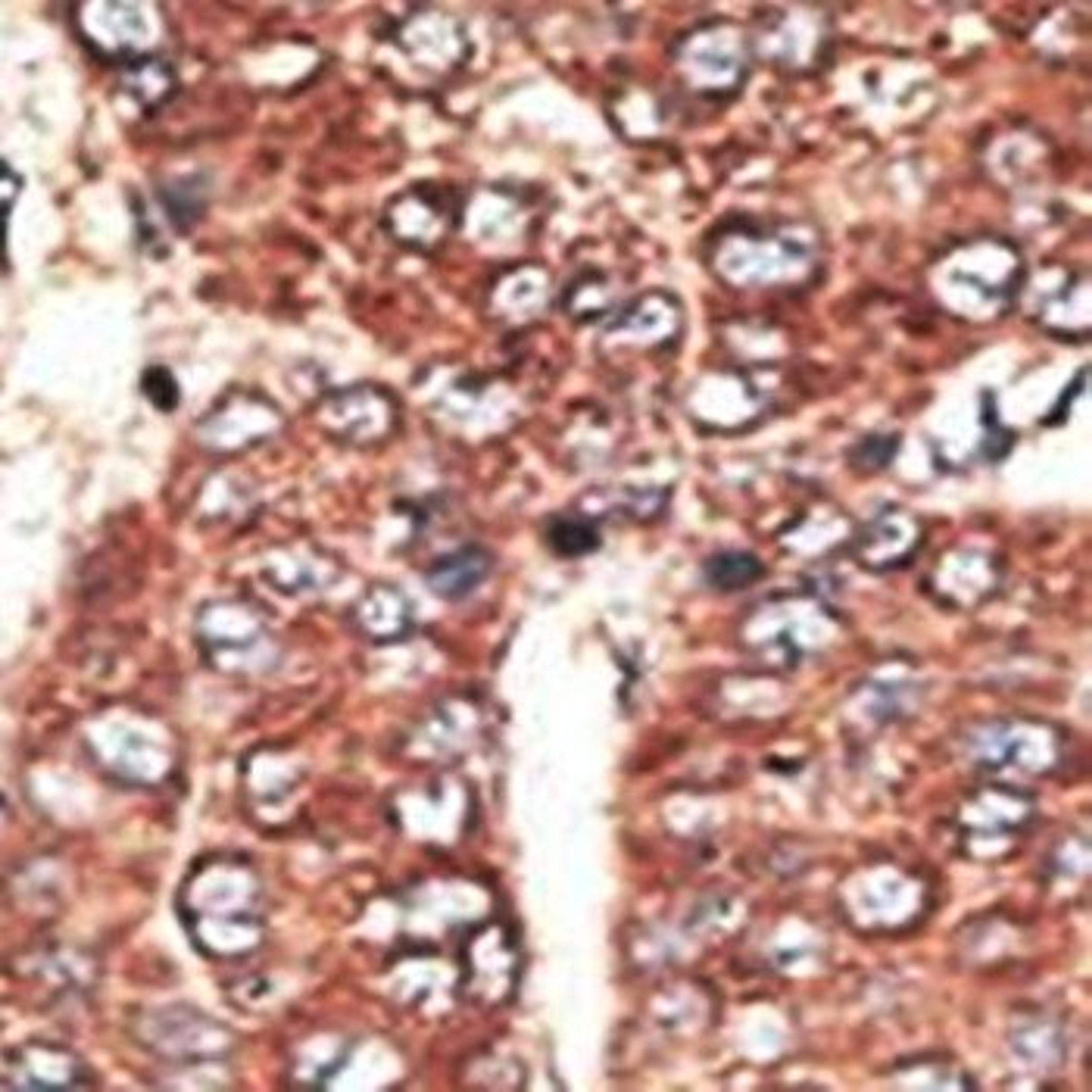 Immunohistochemical analysis of formalin-fixed paraffin embedded human cancer tissue using LRP2 (Megalin) antibody (C-term)