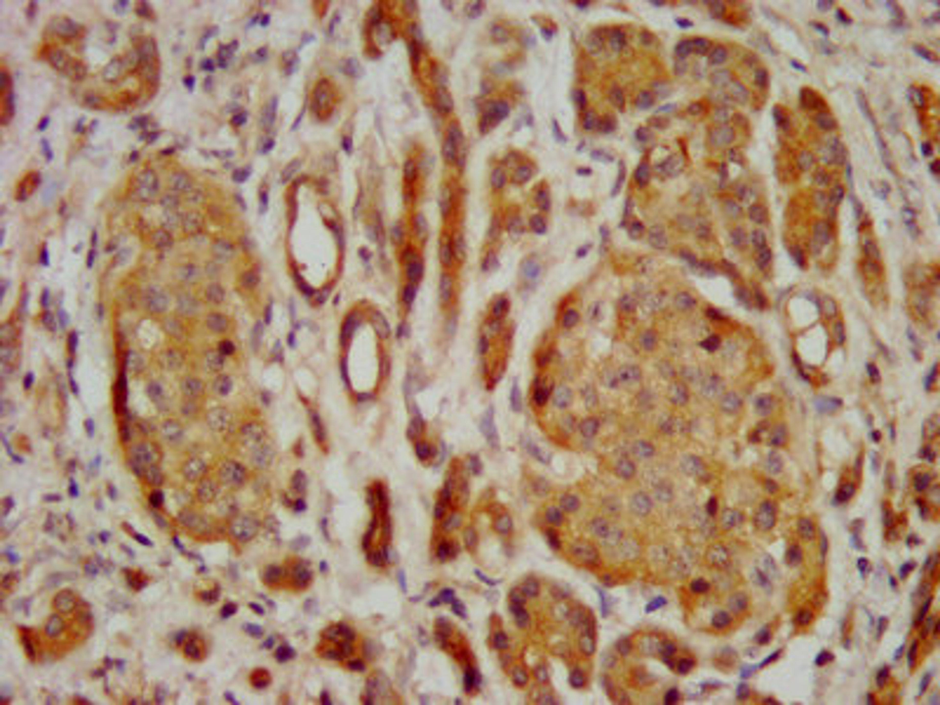 IHC image of CSB-PA722558LA01HU diluted at 1:400 and staining in paraffin-embedded human pancreatic cancer performed on a Leica BondTM system. After dewaxing and hydration, antigen retrieval was mediated by high pressure in a citrate buffer (pH 6.0). Section was blocked with 10% normal goat serum 30min at RT. Then primary antibody (1% BSA) was incubated at 4&deg;C overnight. The primary is detected by a biotinylated secondary antibody and visualized using an HRP conjugated SP system.