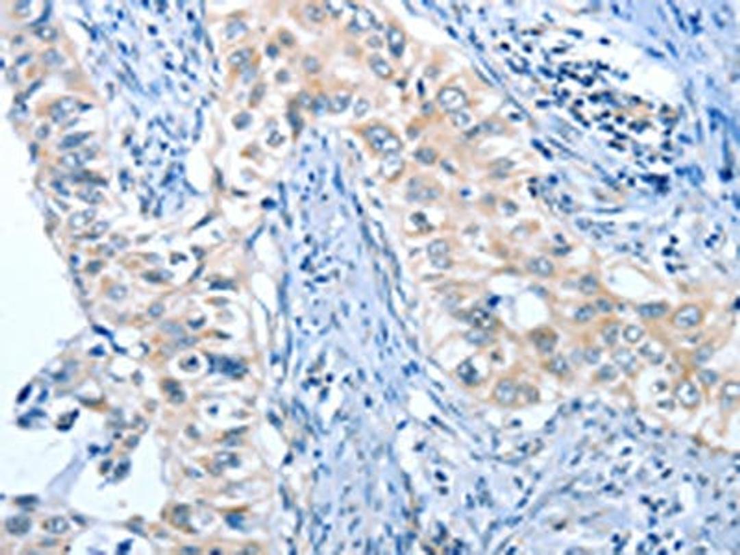 The image on the left is immunohistochemistry of paraffin-embedded Human cervical cancer tissue using CSB-PA083784(ANGPT2 Antibody) at dilution 1/45, on the right is treated with fusion protein. (Original magnification: ×200)