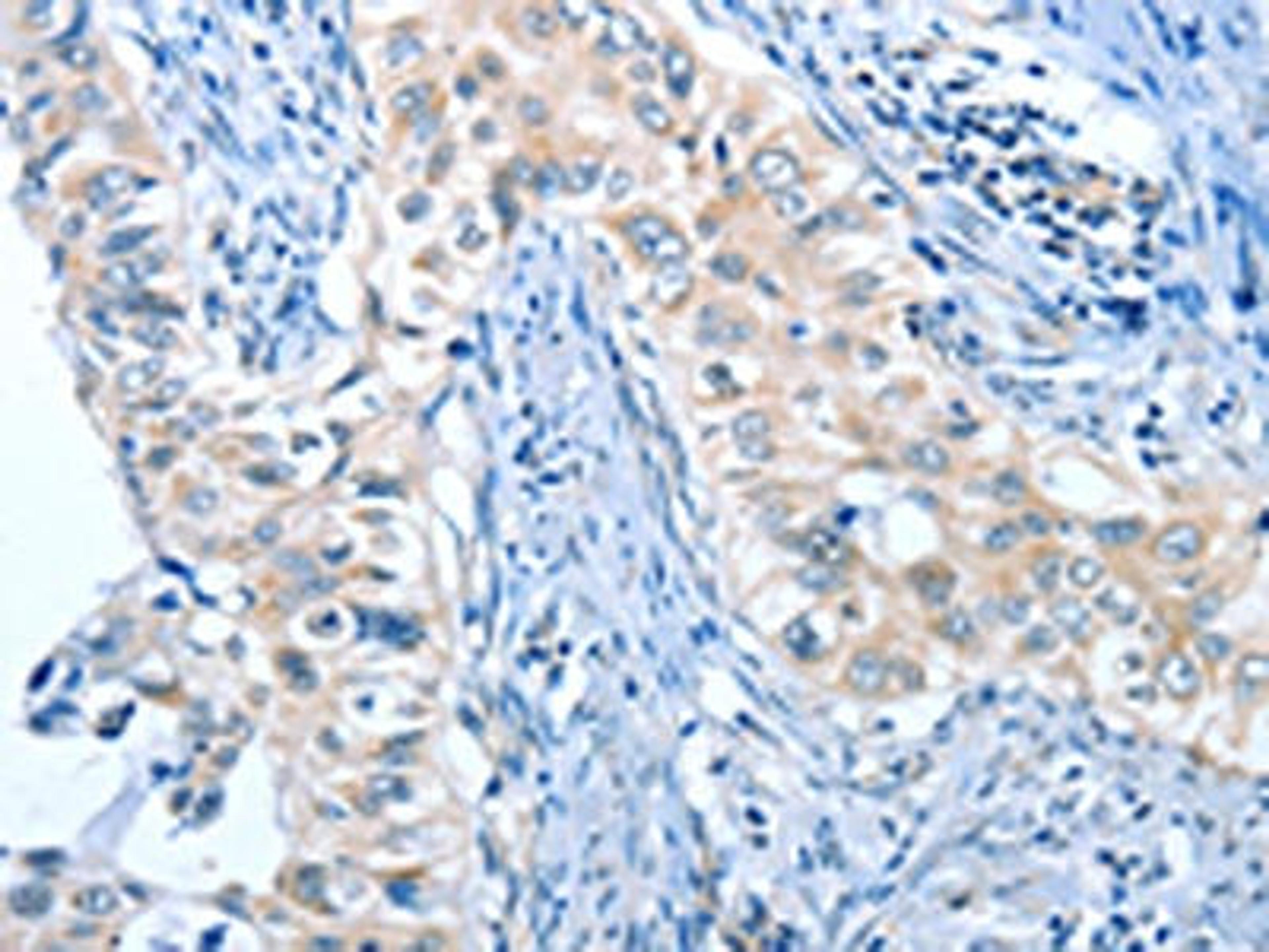 The image on the left is immunohistochemistry of paraffin-embedded Human cervical cancer tissue using CSB-PA083784(ANGPT2 Antibody) at dilution 1/45, on the right is treated with fusion protein. (Original magnification: ×200)