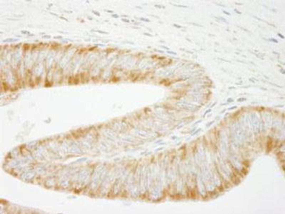 Immunohistochemistry-Paraffin: INPPL1 Antibody [NB100-1592] - FFPE section of human colon carcinoma.  Affinity purified rabbit anti-INPPL1/SHIP2 used at a dilution of 1:250.