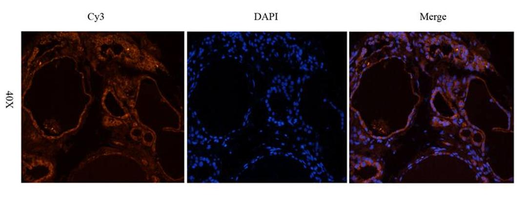 IF analysis of human thyroid cancer tissue using CD69 antibody (2.5 ug/ml)