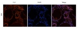 IF analysis of human thyroid cancer tissue using CD69 antibody (2.5 ug/ml)