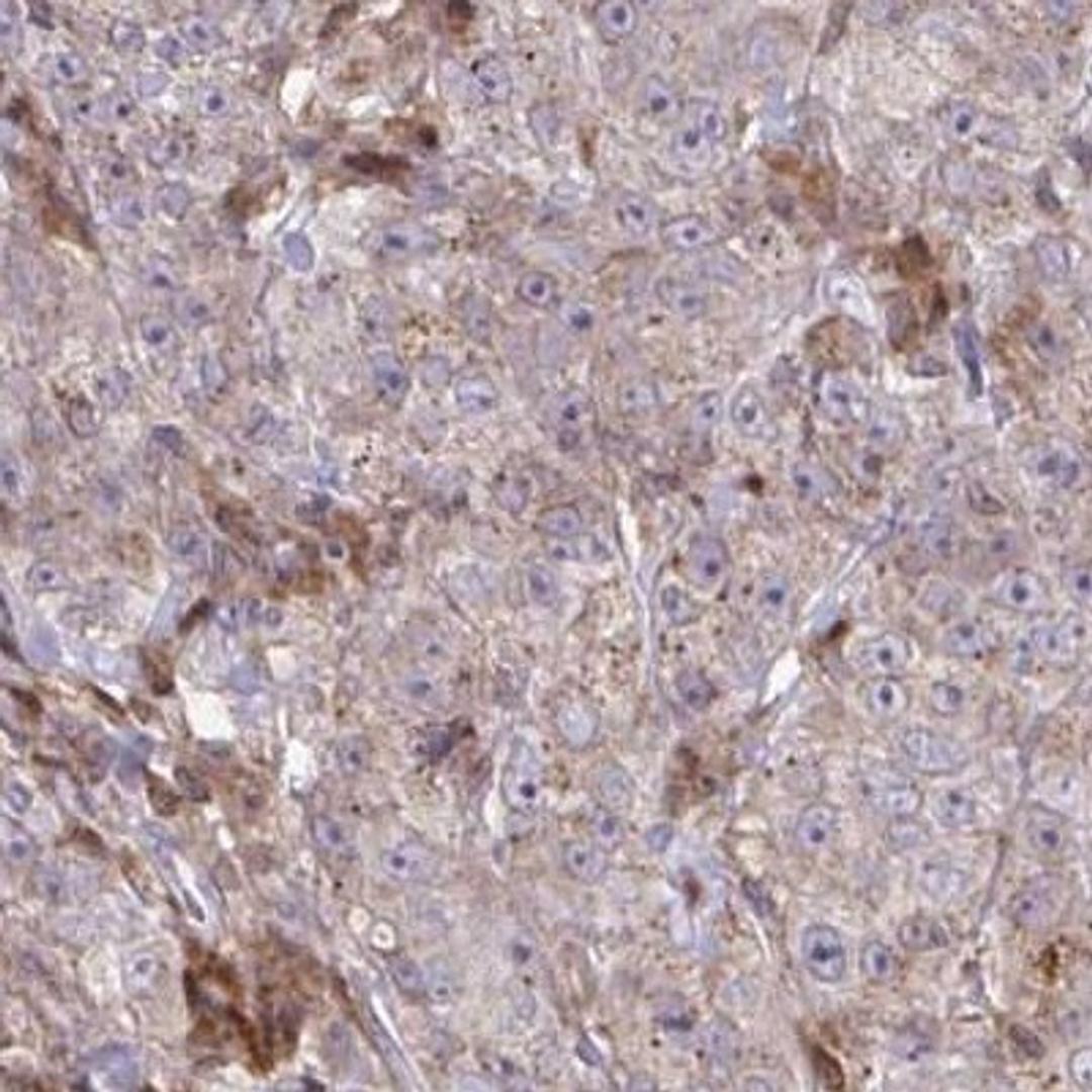 Immunohistochemistry: C16orf54 Antibody [NBP2-32553] - breast cancer