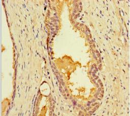 Immunohistochemistry of paraffin-embedded human prostate cancer using CSB-PA012957LA01HU at dilution of 1:100