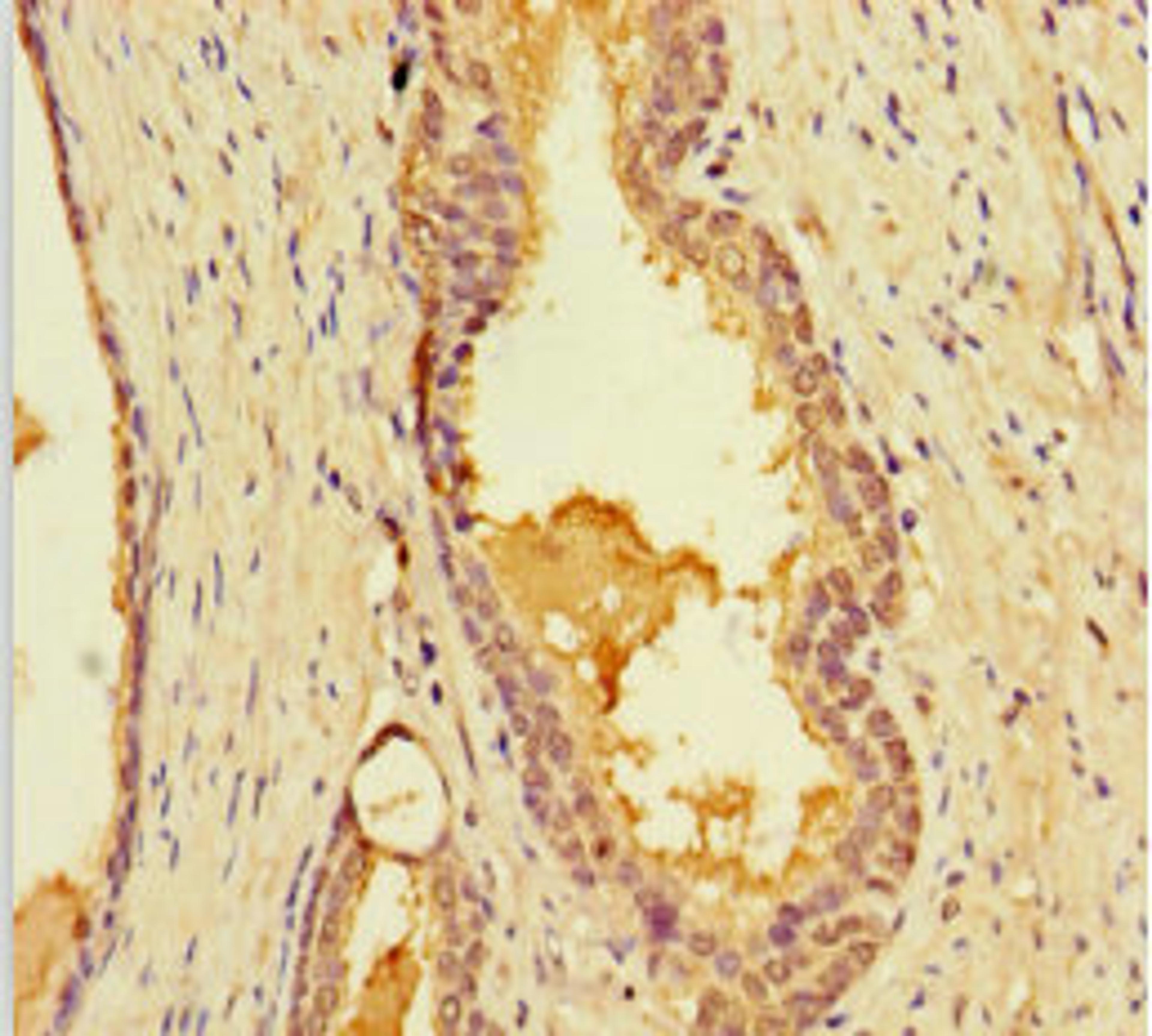 Immunohistochemistry of paraffin-embedded human prostate cancer using CSB-PA012957LA01HU at dilution of 1:100