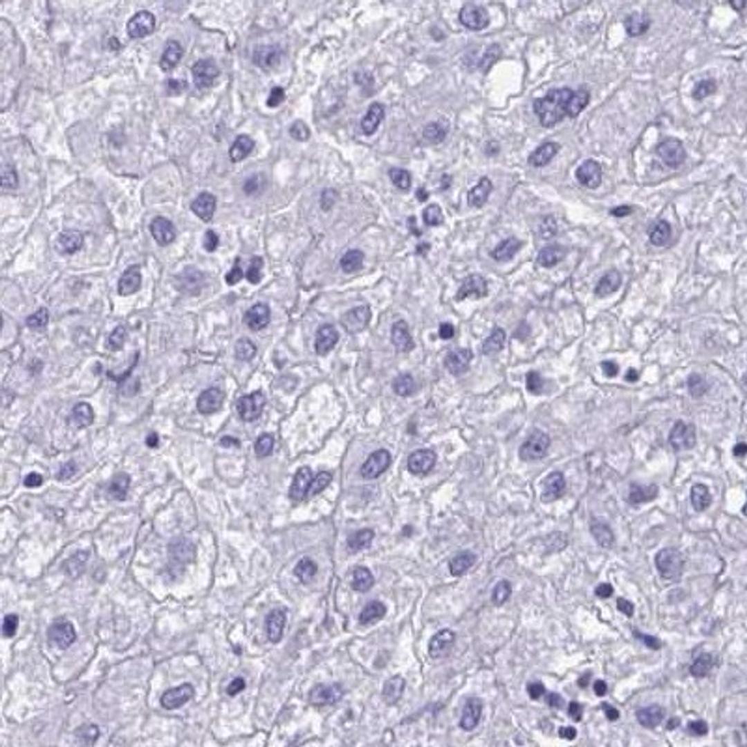 Immunohistochemistry: PGM2L1 Antibody [NBP2-31656] - liver cancer