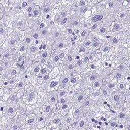 Immunohistochemistry: PGM2L1 Antibody [NBP2-31656] - liver cancer