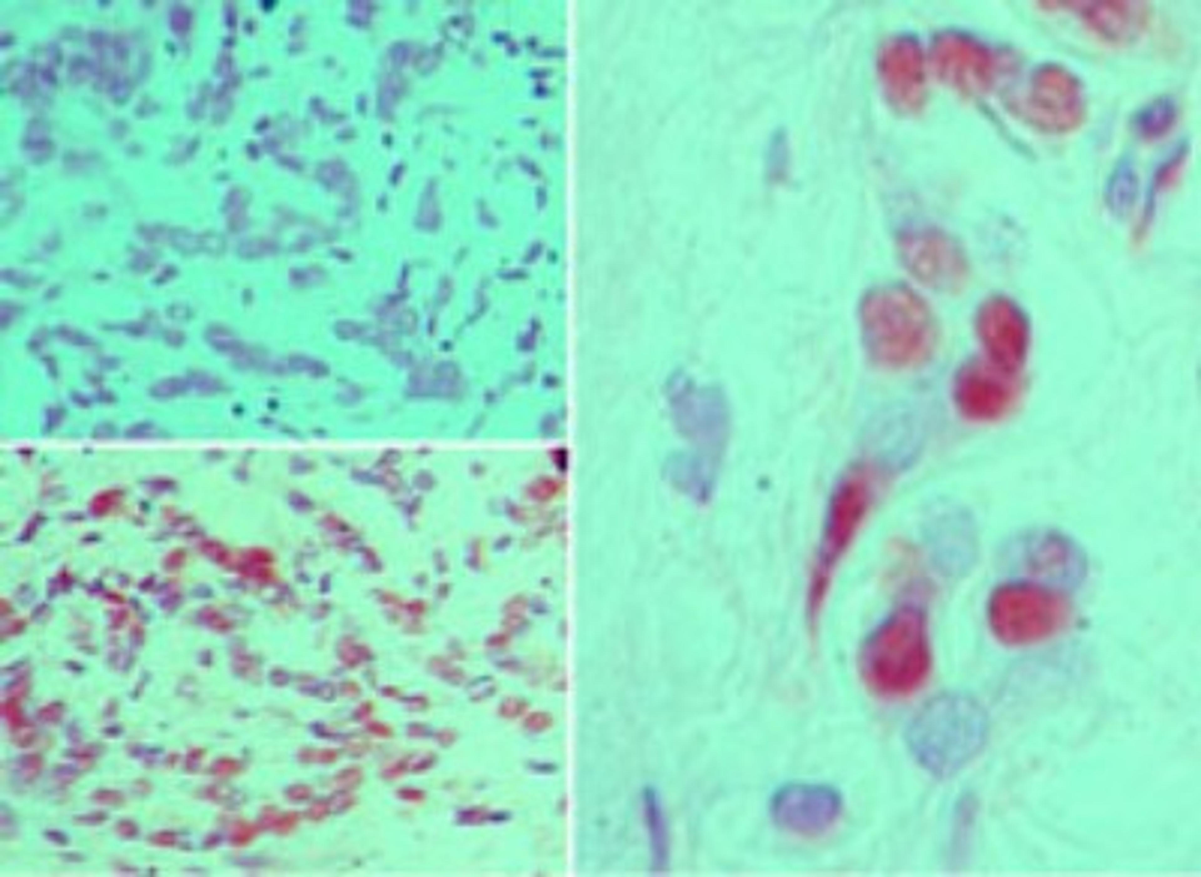 Immunohistochemistry-Paraffin: FGFR1 [p Tyr651, p Tyr652] Antibody [NBP2-24462] - Immunohistochemical analysis of FGFR1 phospho in formalin-fixed, paraffin-embedded human breast tumor tissue using an isotype control antibody (top left) and FGFR1 phospho antibody (bottom left, right) at 5 ug/ml.