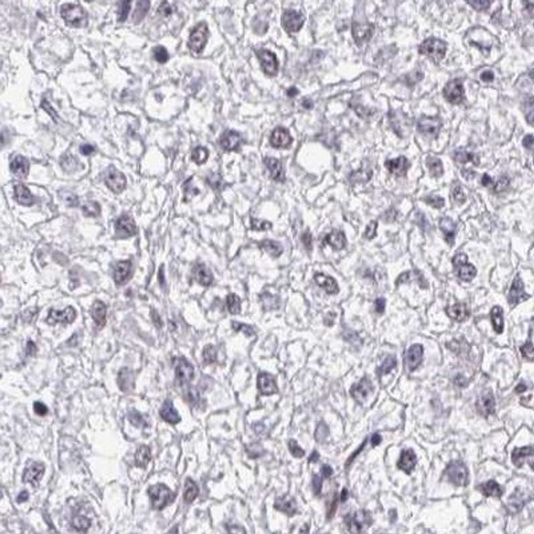 Immunohistochemistry: GNPAT Antibody [NBP2-32510] - liver cancer