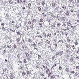 Immunohistochemistry: GNPAT Antibody [NBP2-32510] - liver cancer