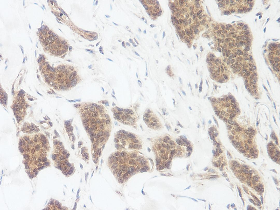 This antibody stained formalin-fixed, paraffin-embedded sections of human breast invasive ductal carcinoma. The recommended concentration is 0.125 ug/ml - 0.25 ug/ml with an overnight incubation at 4&#730;C. An HRP-labeled polymer detection system was use