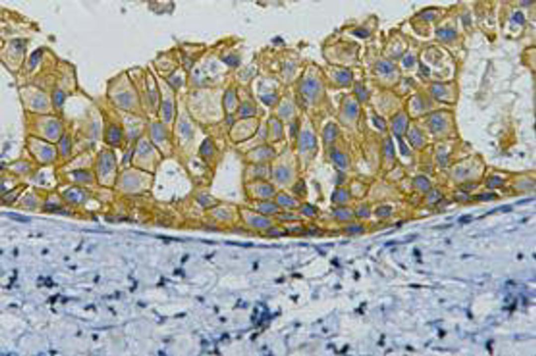 IHC staining of human breast cancer tissue, diluted at 1:200.