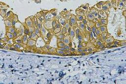 IHC staining of human breast cancer tissue, diluted at 1:200.