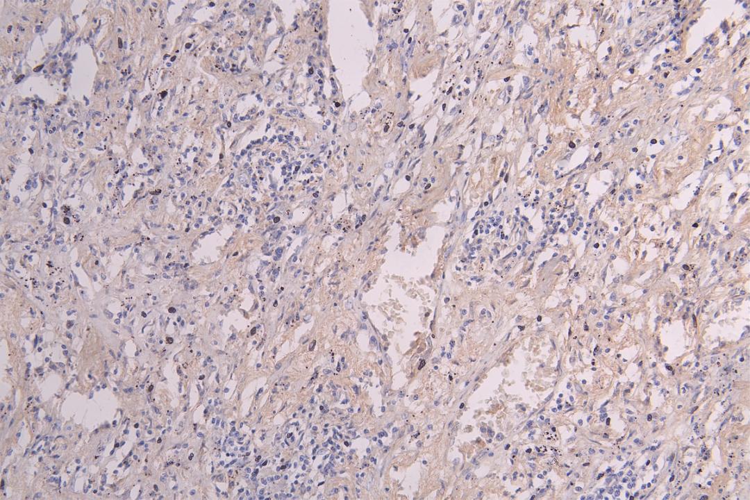 IHC image of CSB-RA011048MA1HU diluted at 1:300 and staining in paraffin-embedded human lung cancer performed on a Leica BondTM system. After dewaxing and hydration, antigen retrieval was mediated by high pressure in a citrate buffer (pH 6.0). Section was blocked with 10% normal goat serum 30min at RT. Then primary antibody (1% BSA) was incubated at 4°C overnight. The primary is detected by a Goat anti-Human IgG labeled by HRP and visualized using 0.05% DAB.