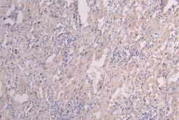 IHC image of CSB-RA011048MA1HU diluted at 1:300 and staining in paraffin-embedded human lung cancer performed on a Leica BondTM system. After dewaxing and hydration, antigen retrieval was mediated by high pressure in a citrate buffer (pH 6.0). Section was blocked with 10% normal goat serum 30min at RT. Then primary antibody (1% BSA) was incubated at 4°C overnight. The primary is detected by a Goat anti-Human IgG labeled by HRP and visualized using 0.05% DAB.