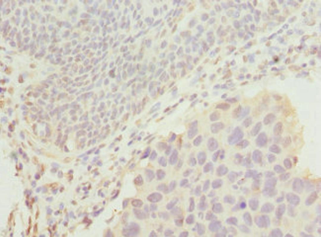 Immunohistochemistry of paraffin-embedded human bladder cancer using CSB-PA866601ESR1HU at dilution of 1:100