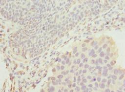 Immunohistochemistry of paraffin-embedded human bladder cancer using CSB-PA866601ESR1HU at dilution of 1:100