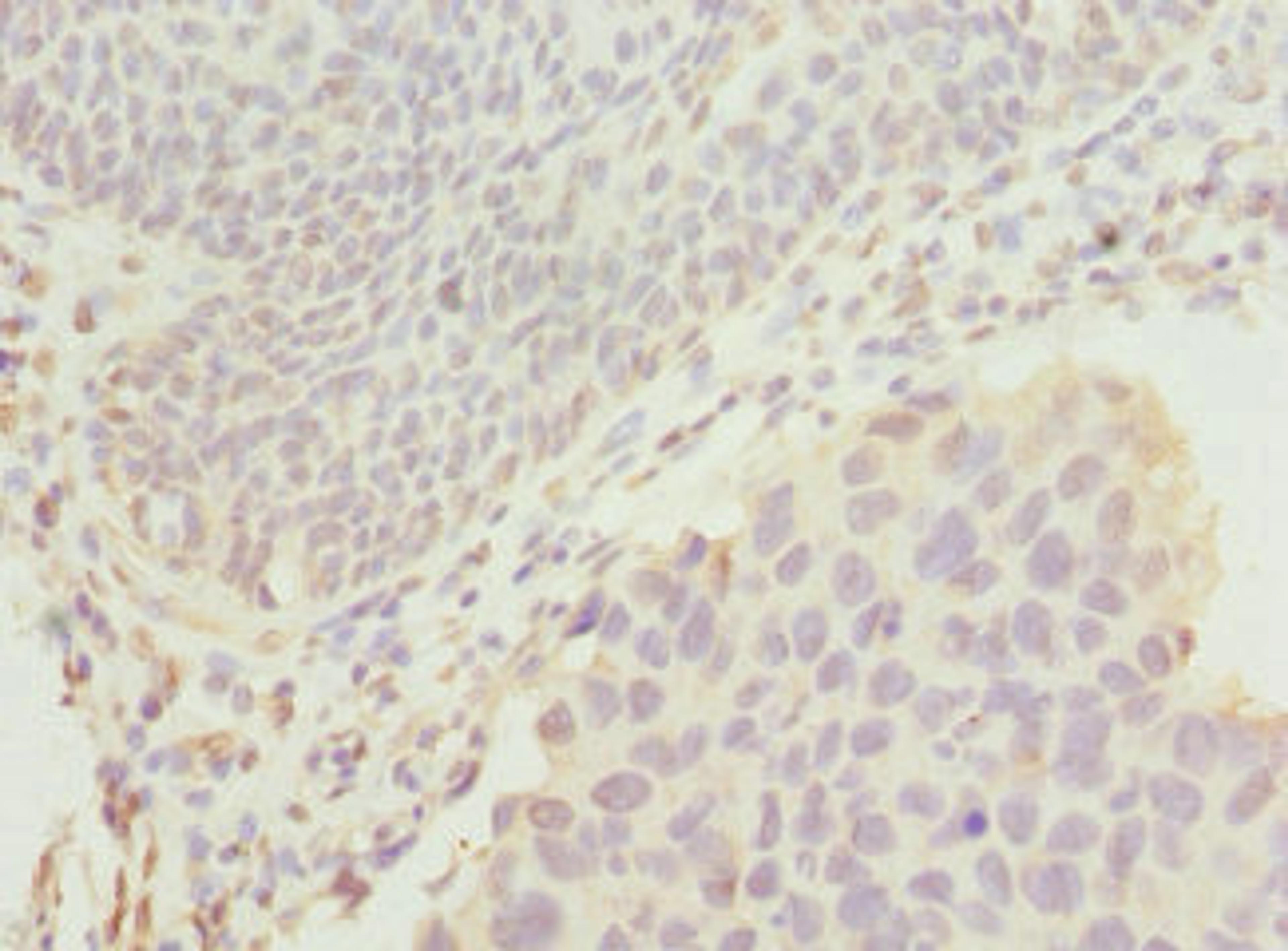 Immunohistochemistry of paraffin-embedded human bladder cancer using CSB-PA866601ESR1HU at dilution of 1:100