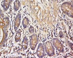 Immunohistochemical staining of human colon cancer tissue using VAMP3 antibody.