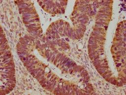 Immunohistochemical of paraffin-embedded human ovarian cancer using CSB-MA0128871A0m at dilution of 1:100