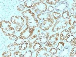 Immunohistochemical staining of Human renal cell carcinoma using Laminin gamma 1 antibody