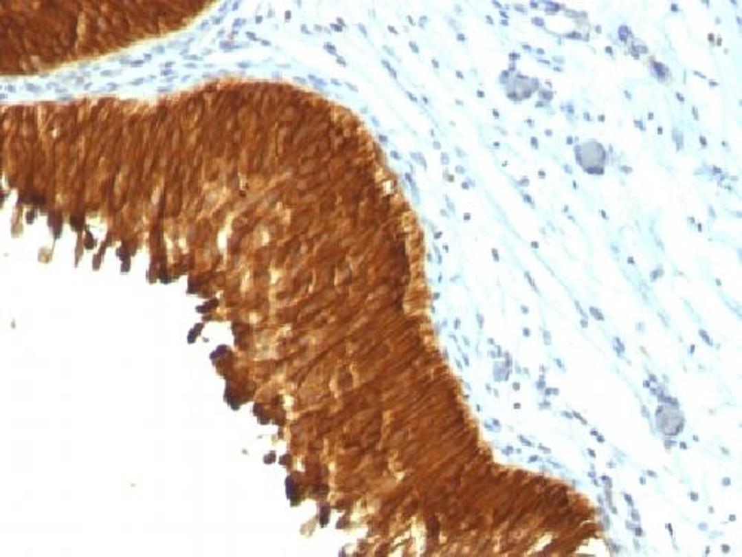 Immunohistochemical staining of human Bladder Carcinoma tissue using Multiple antibody