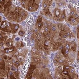 Immunohistochemistry: UGT3A2 Antibody [NBP2-32468] - liver cancer