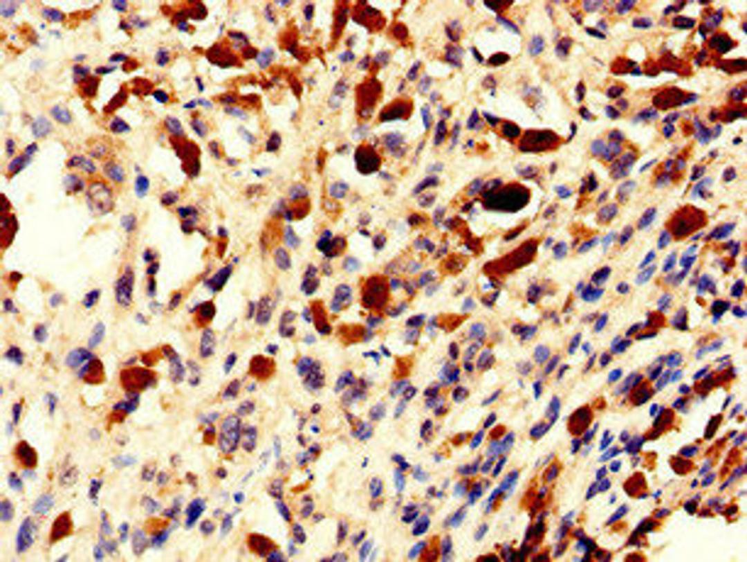 Immunohistochemistry of paraffin-embedded human melanoma using CSB-PA873677LA01HU at dilution of 1:100