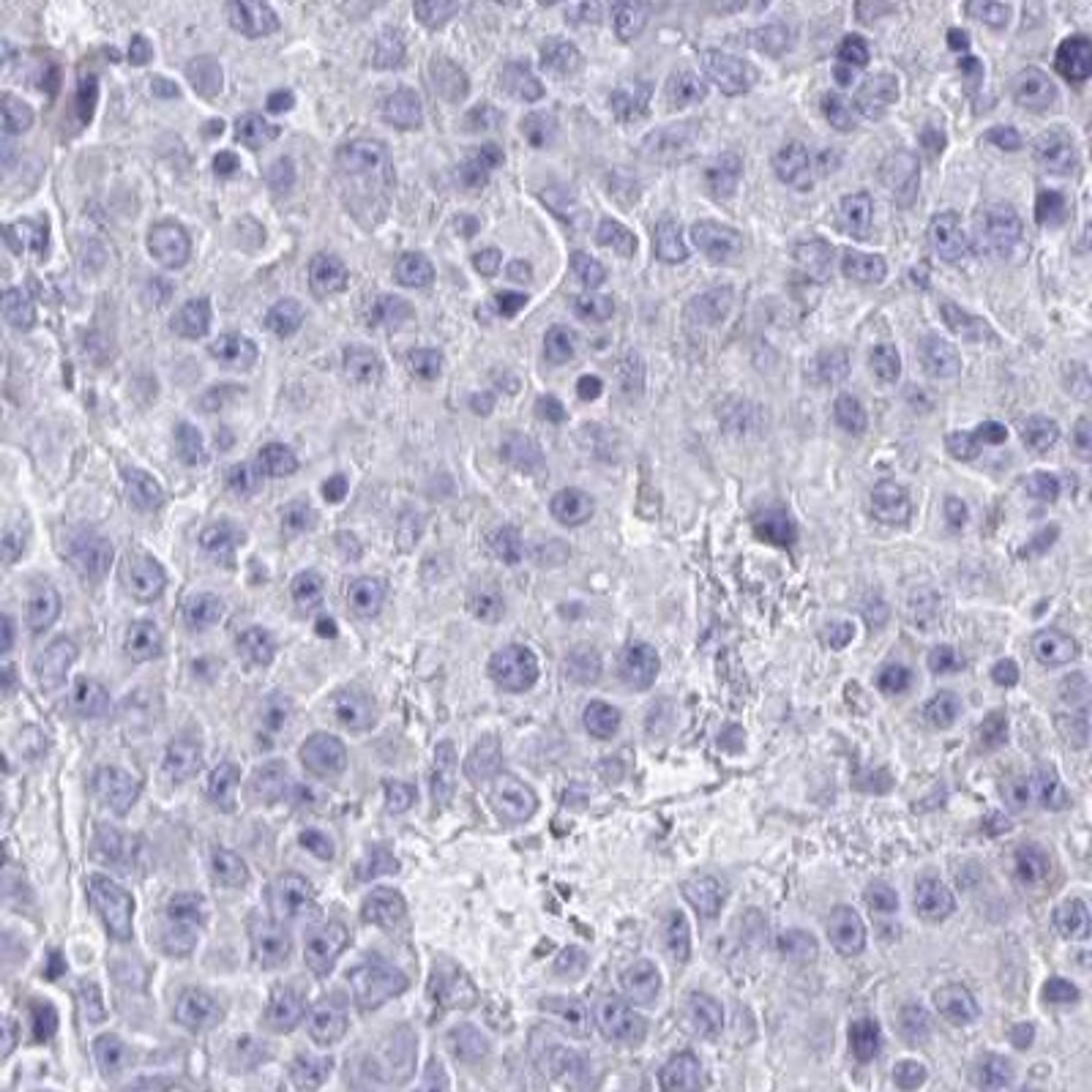 Immunohistochemistry: IL17D Antibody [NBP2-31824] - liver cancer