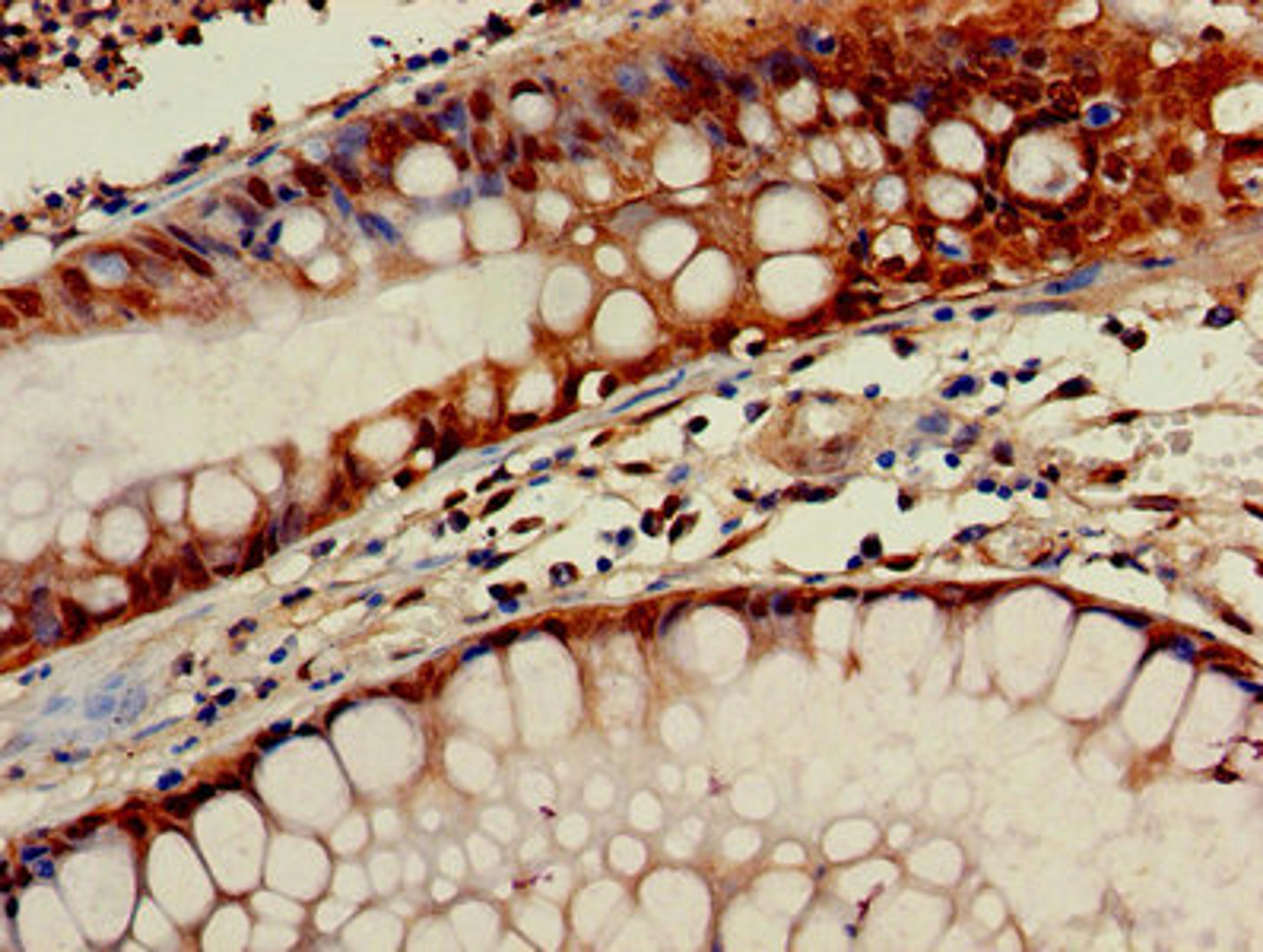 Immunohistochemistry of paraffin-embedded human colon cancer using CSB-PA009610LA01HU at dilution of 1:100