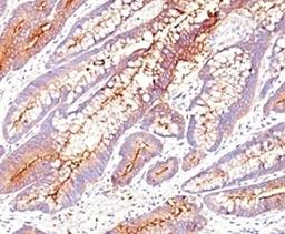 Formalin-fixed, paraffin-embedded human colon carcinoma stained with CEA antibody (SPM584).