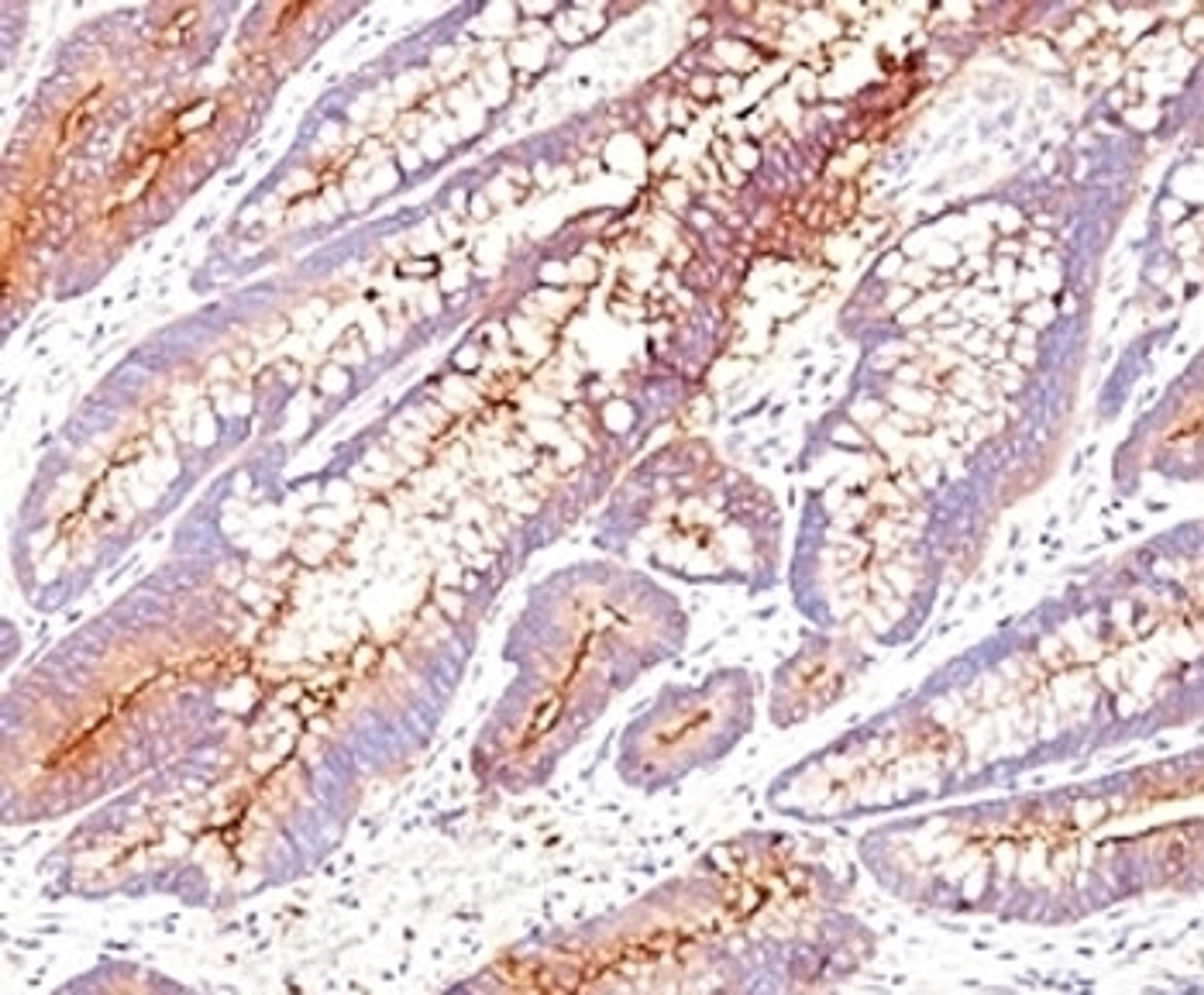 Formalin-fixed, paraffin-embedded human colon carcinoma stained with CEA antibody (SPM584).