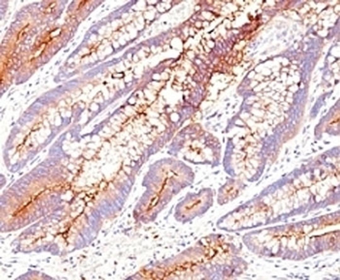 Formalin-fixed, paraffin-embedded human colon carcinoma stained with CEA antibody (SPM584).