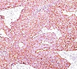 IHC testing of human small cell lung carcinoma stained with Chromogranin A antibody.